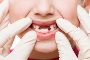 Diş Neden Sallanır? Tedavisi Nasıl Yapılır?